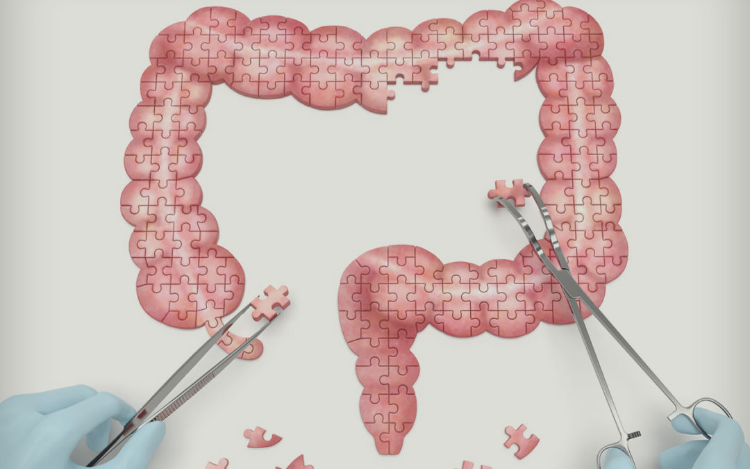 Illustration of colon defined by jigsaw puzzel with someone removing puzzle pieces